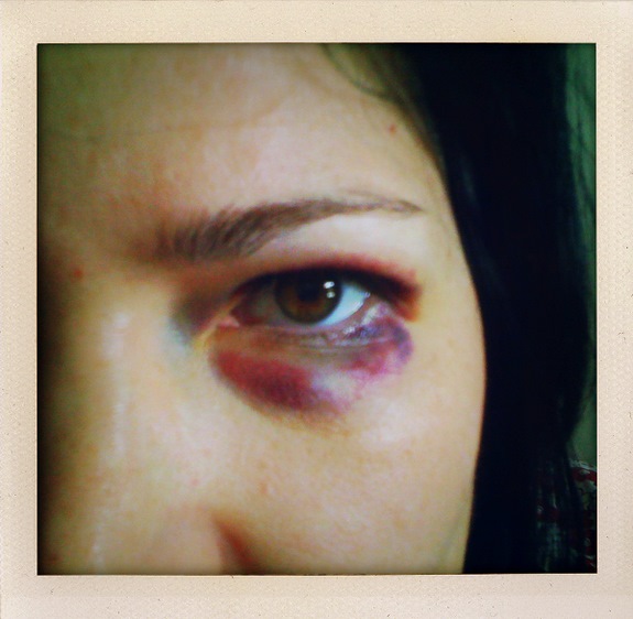 black eye black eyes